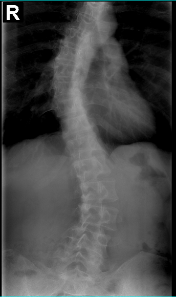 Double curved scoliosis 